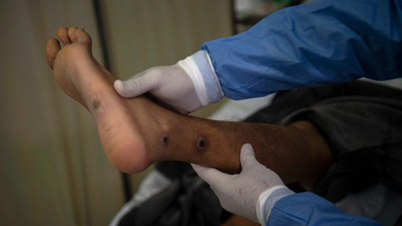 Confirman primer caso del año de viruela de mono en Quintana Roo