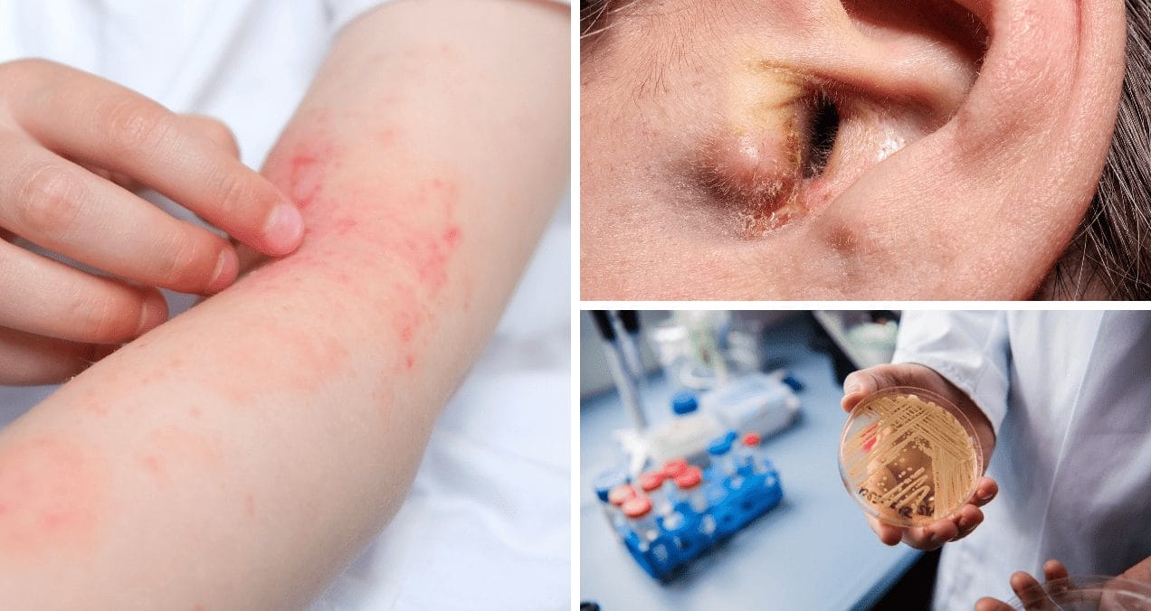 Candida Auris: Alerta máxima por hongo resistente y letal