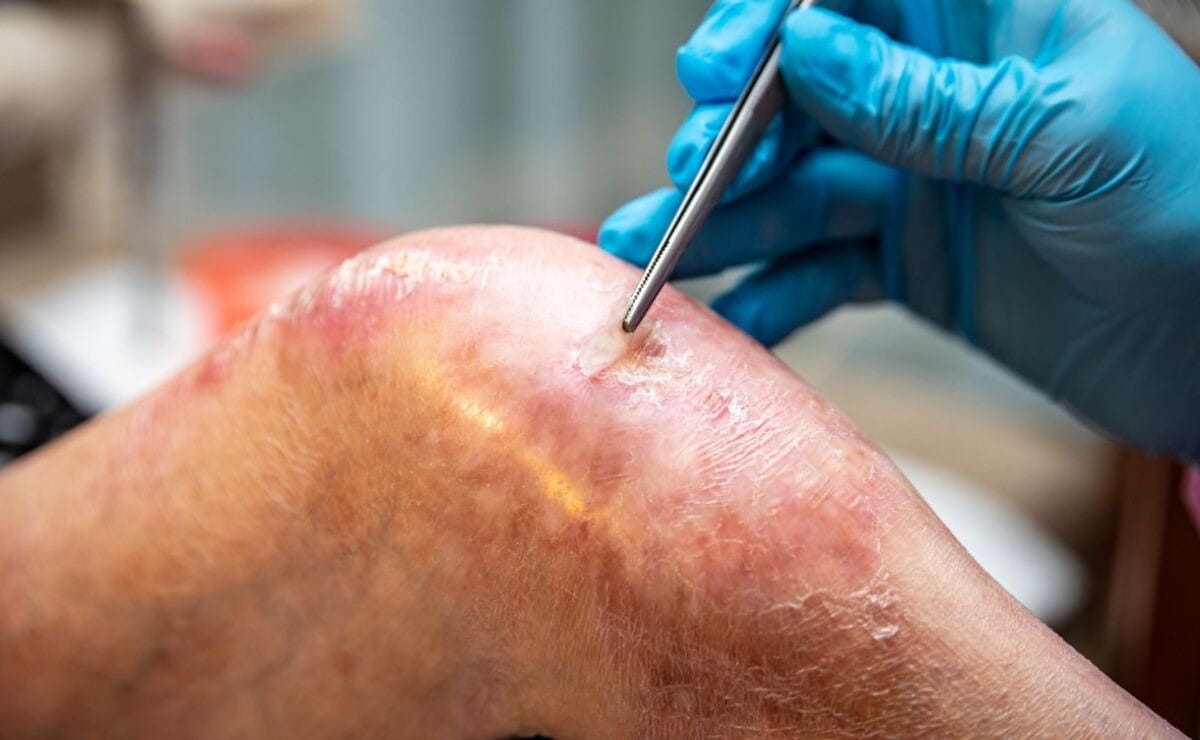 Surge esperanza para la "Piel de Mariposa" en California