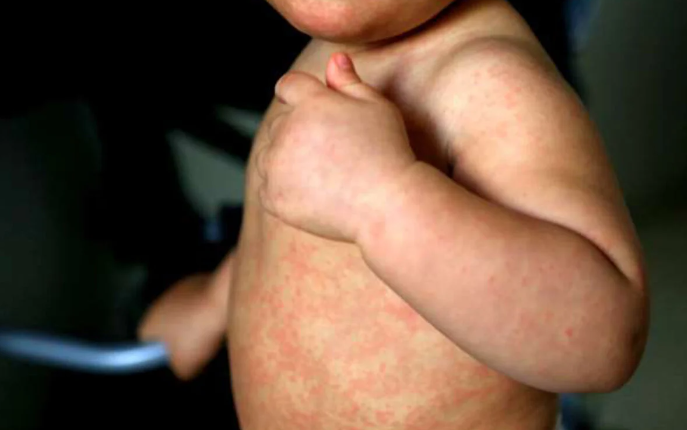 Confirman nuevo caso de sarampión en Quintana Roo; van 9 en la Península Confirman nuevo caso de sarampión en Quintana Roo; van 9 en la Península