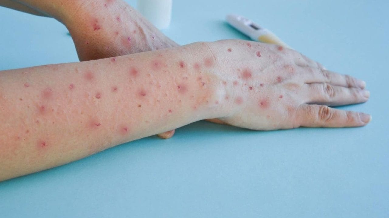 Sarampión en países ricos: Causas y riesgos del resurgimiento 2025