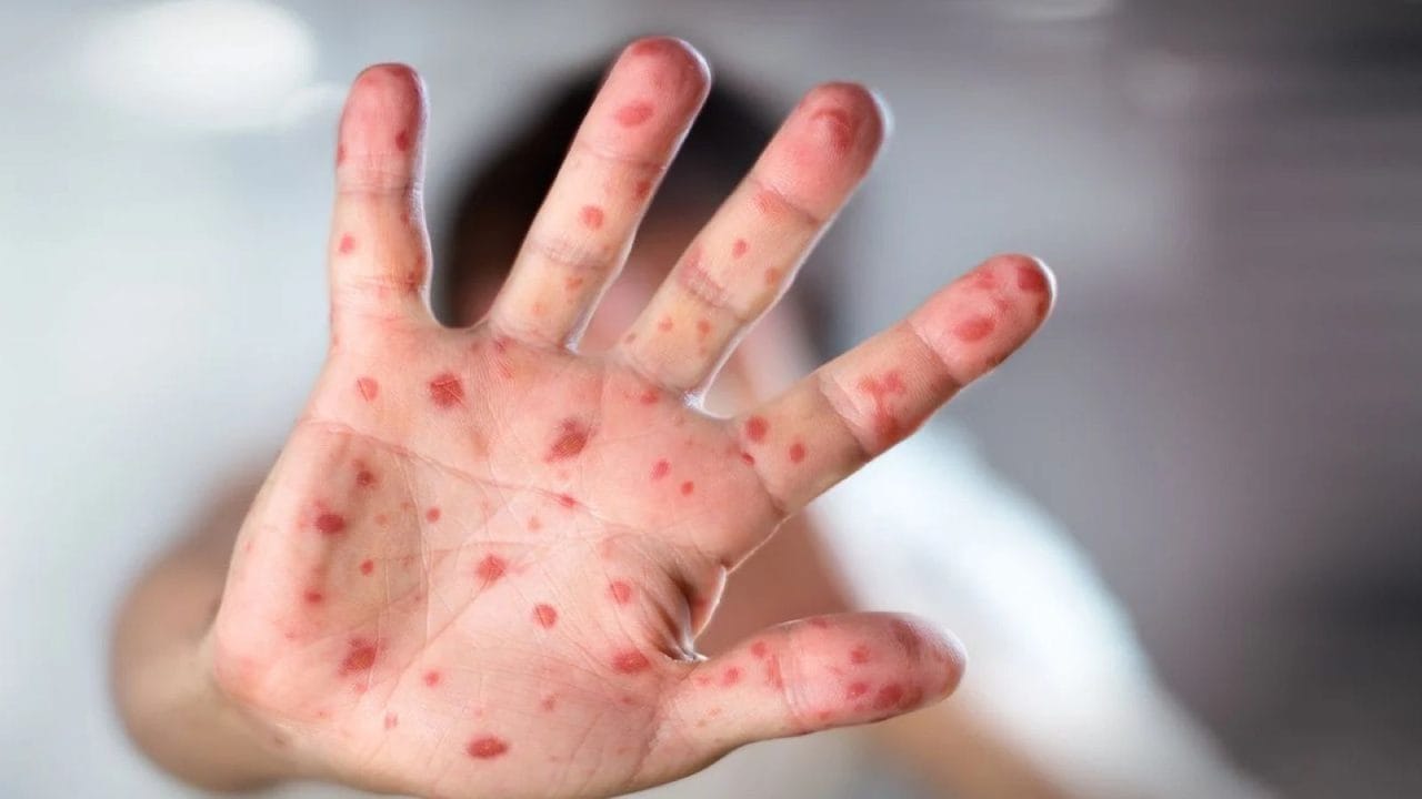 Alerta sanitaria: Sarampión ya mató a 8 en Chihuahua