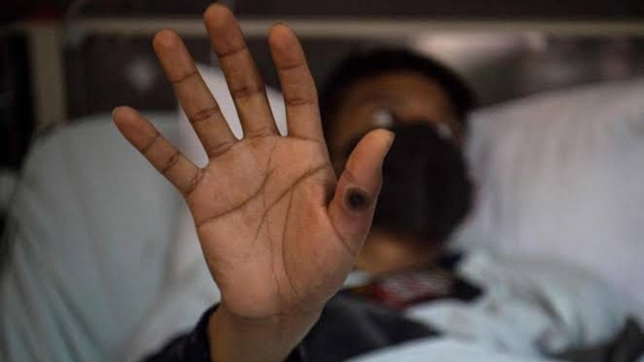 Confirman cuarto caso de viruela de mono en Quintana Roo, van 5 en la península