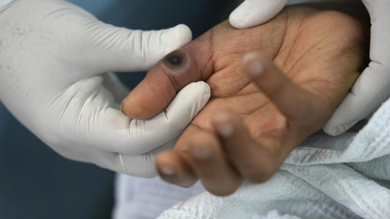 Confirman dos casos nuevos de viruela de mono en la península, van siete en el año Confirman dos casos nuevos de viruela de mono en la península, van siete en el año