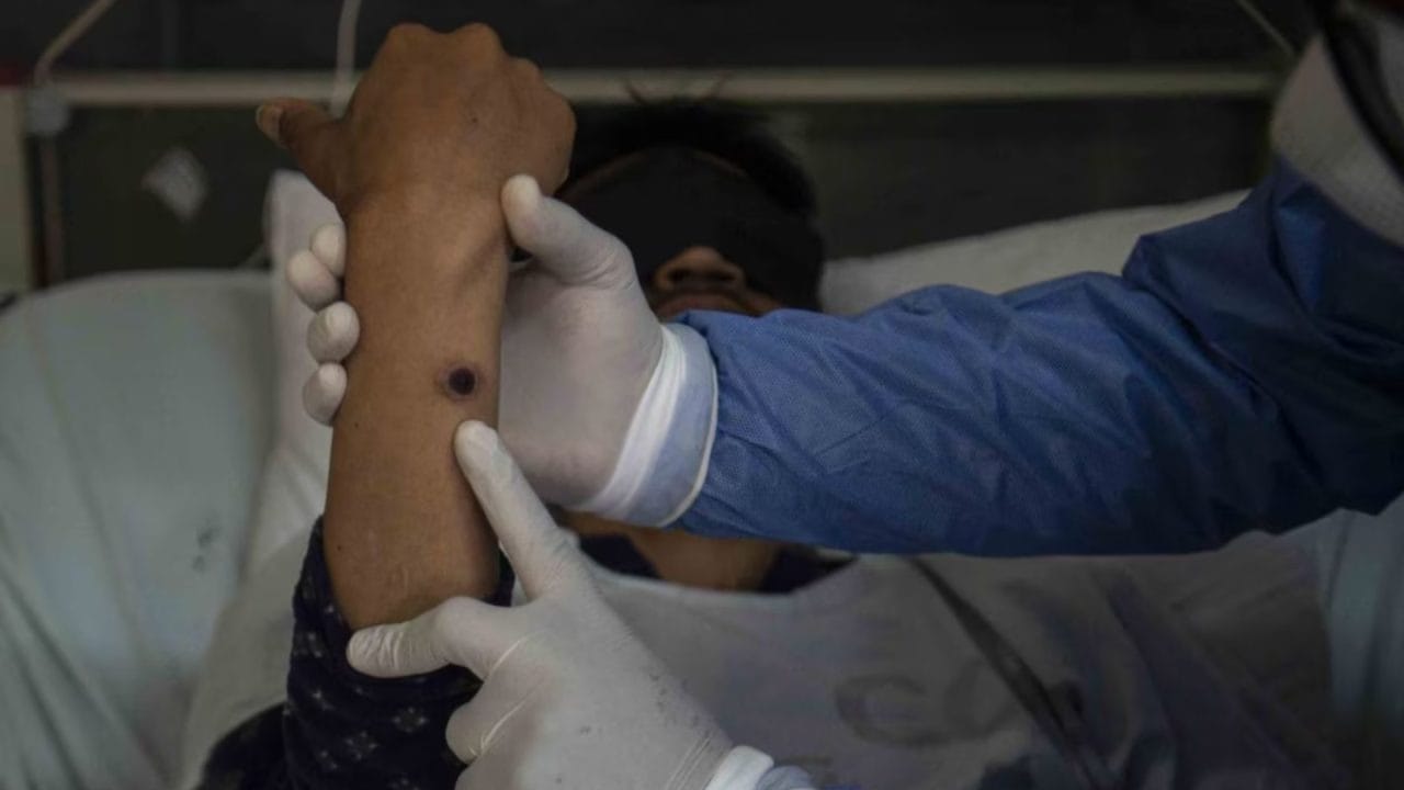 Confirman tercer caso de viruela del mono en Yucatán; suman 9 en la península Confirman tercer caso de viruela del mono en Yucatán; suman 9 en la península