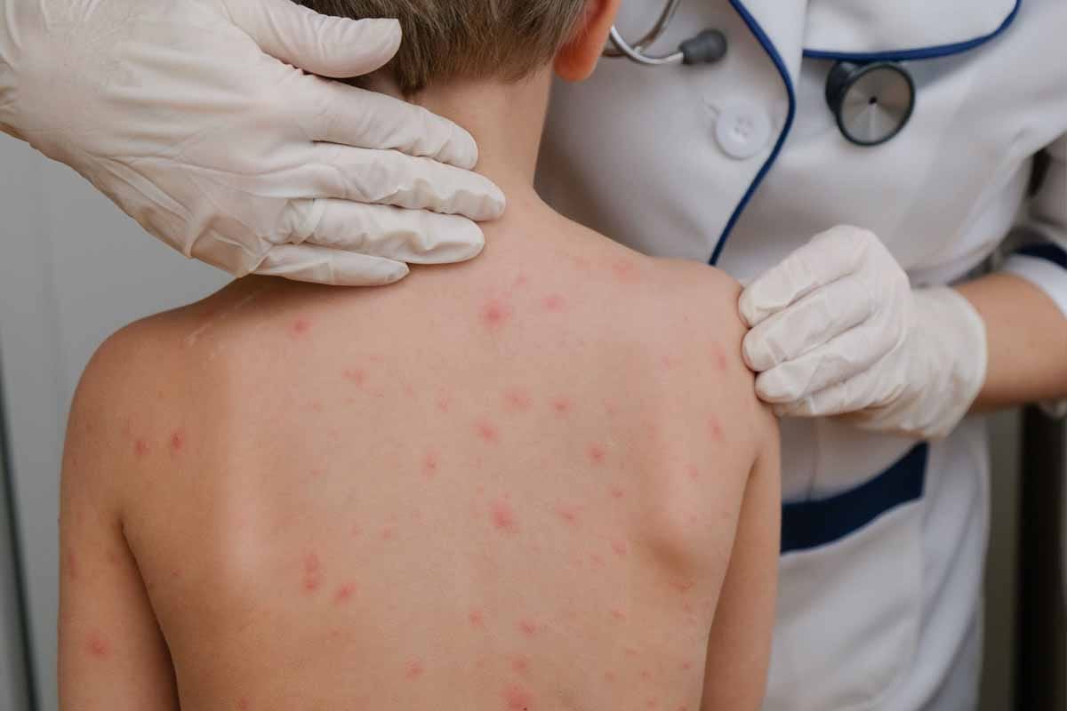 Sarampión se dispara en América: 7 mil casos y alerta de la OPS