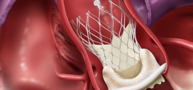 TAVI_ la cirugía cardíaca sin abrir el pecho que salva vidas