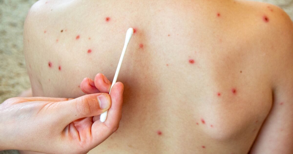 Sarampión en México: Prevención y Esquema de Vacunación Esencial