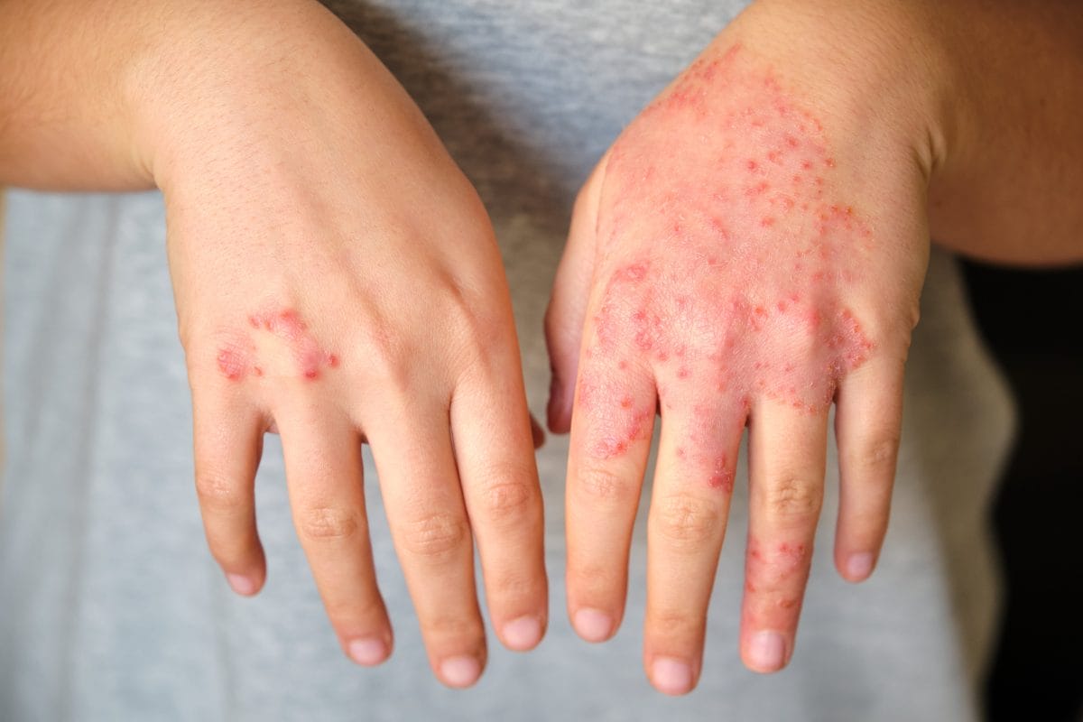 eccemas_alergia El vínculo oculto entre el eccema y las alergias graves