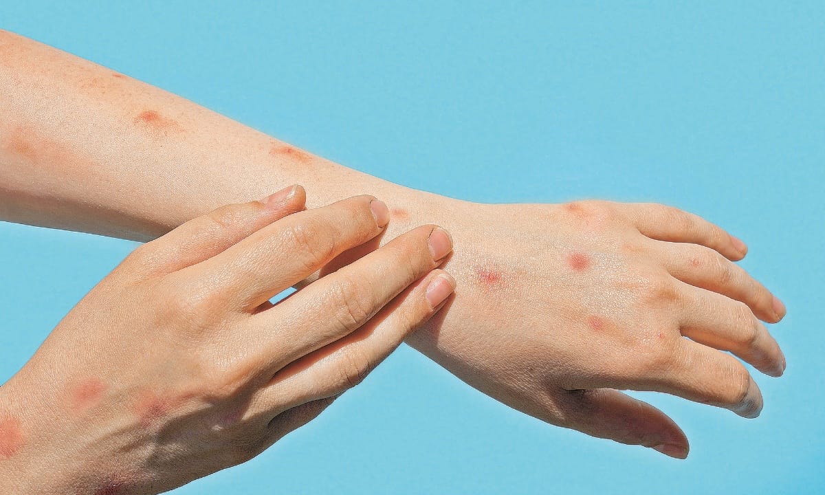 viruela_simica_muerte_confirmada_jalisco Viruela símica: Jalisco reporta su primer fallecimiento confirmado