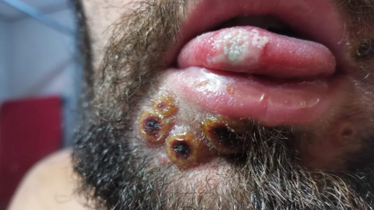 Viruela del mono, las cicatrices que deja la enfermedad en la piel Viruela del mono, las cicatrices que deja la enfermedad en la piel