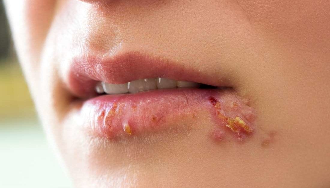 Herpes, una infección invisible_ cómo y por qué puede aparecer tras años oculta Herpes, una infección invisible: cómo y por qué puede aparecer tras años oculta
