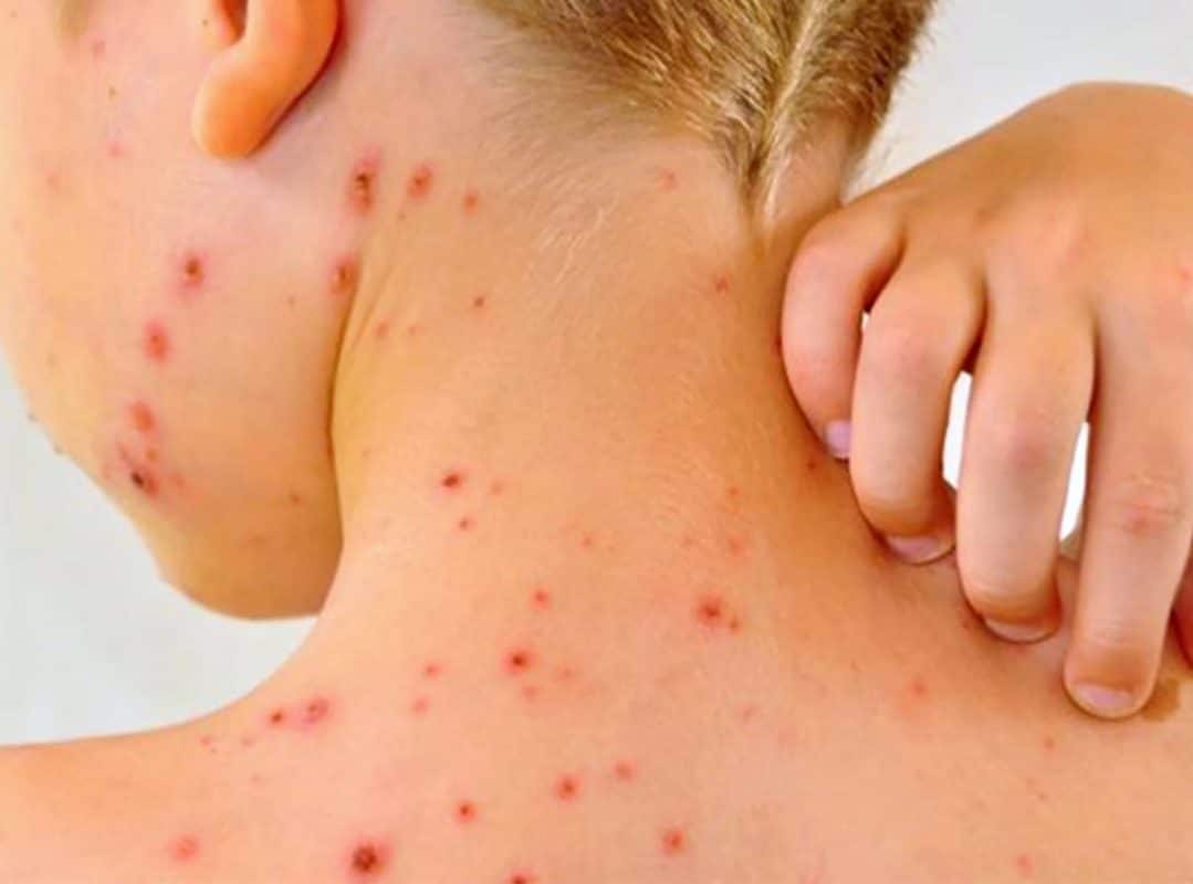 Muertes por sarampión en Chihuahua llegan a 20; mayoría sin vacunación