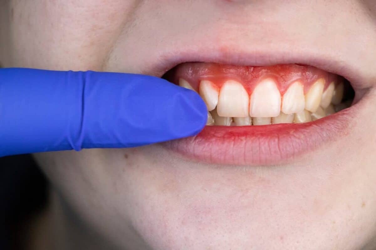 Sangrado e inflamación de encías: alerta de una crisis de salud bucal