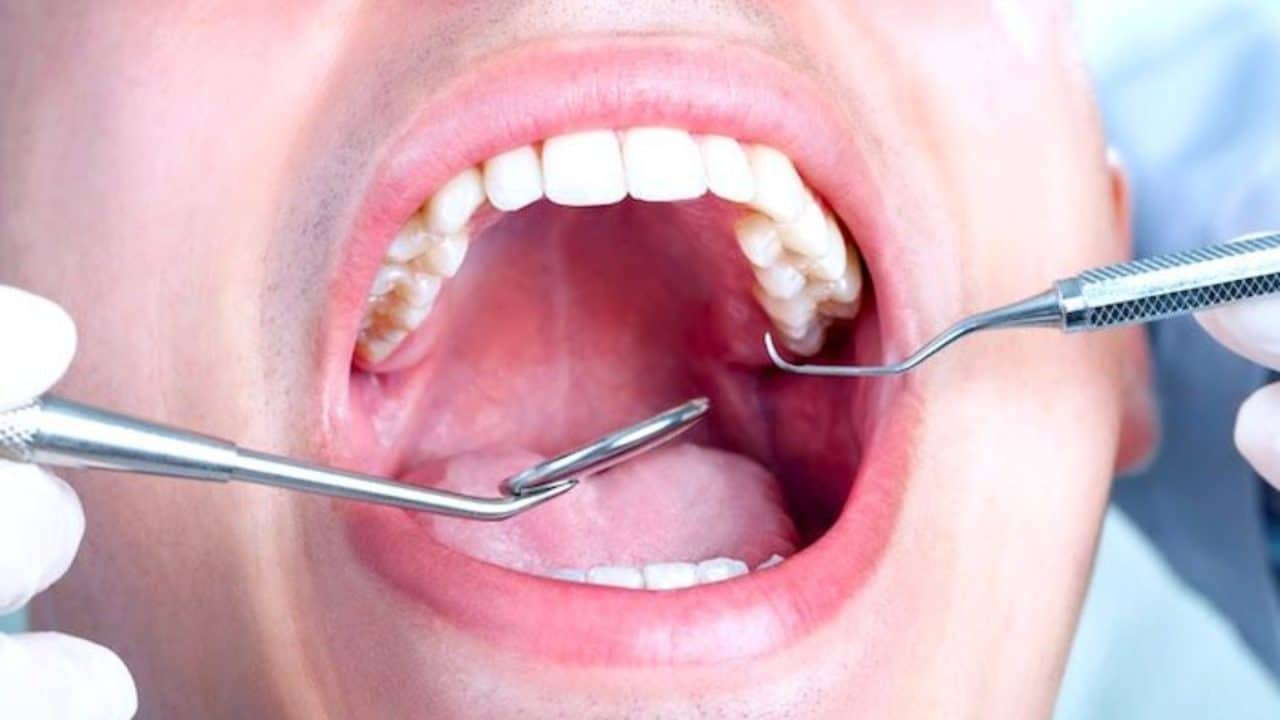 Cuidados que debes tomar en cuenta tras la extracción de la muela del juicio