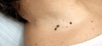 Cómo quitar verrugas del cuello sin riesgos: tratamientos caseros y médicos