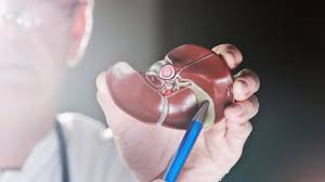 Cirrosis hepática, una amenaza creciente: especialistas alertan sobre su avance en México