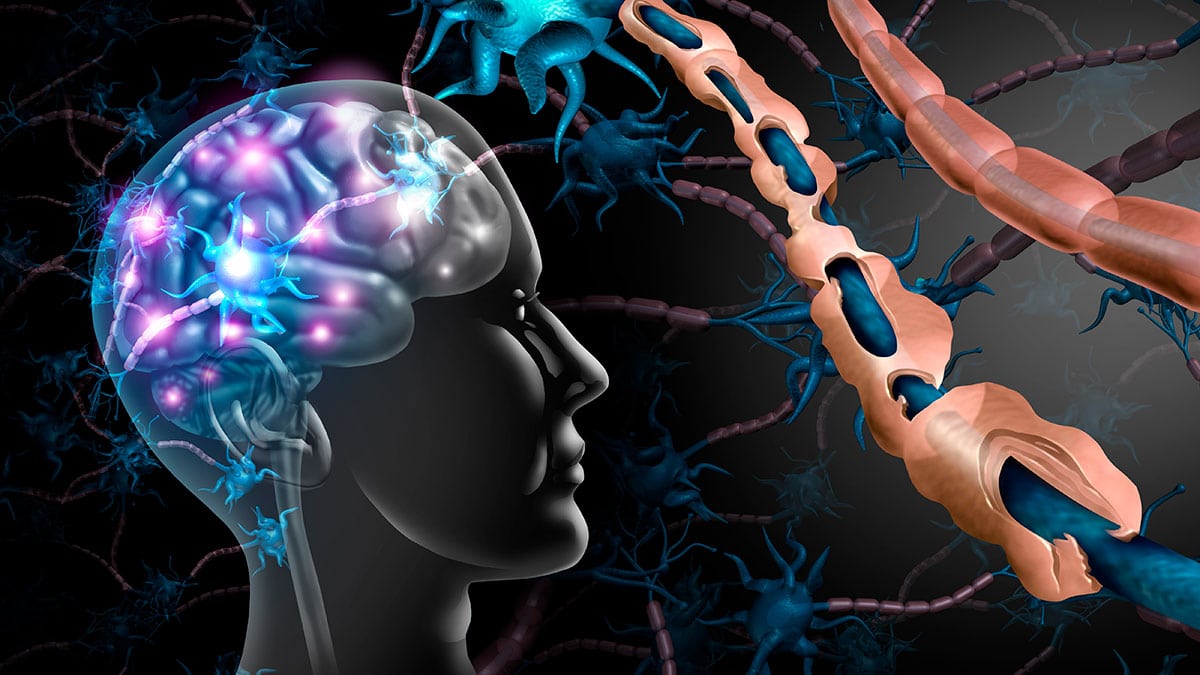 Esclerosis múltiple: qué es, síntomas y daños que provoca