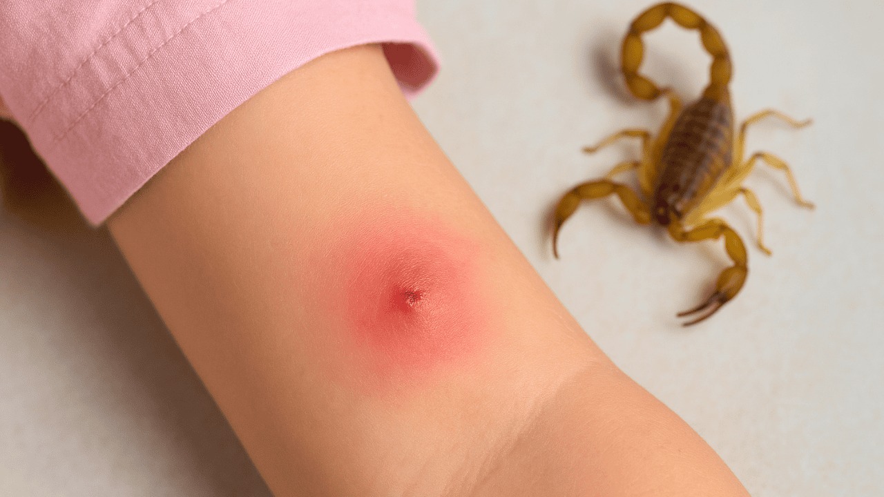 Muere niña de 5 años por picadura de alacrán en Hermosillo Muere niña de 5 años por picadura de alacrán en Hermosillo