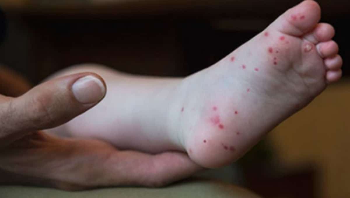 Brote del virus coxsackie: síntomas y estados con suspensión de clases por casos