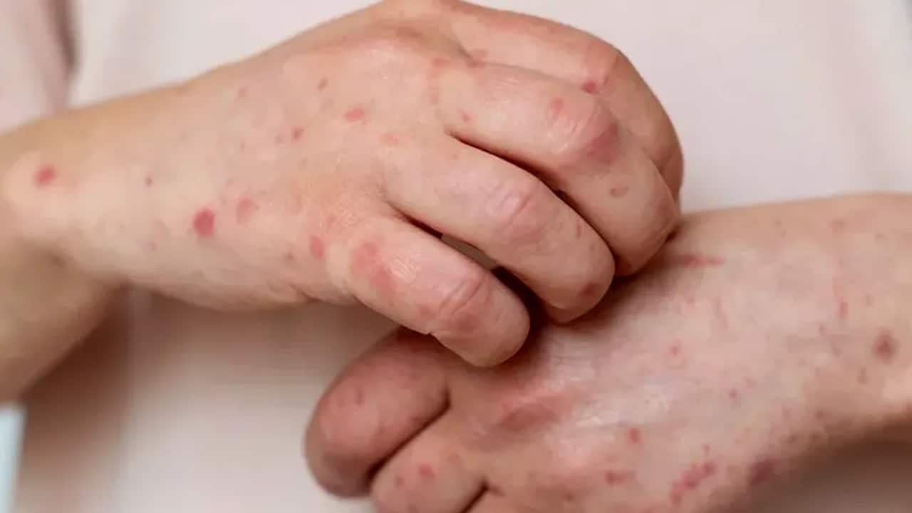 Casos de sarampión en Jalisco provocan suspensión de clases