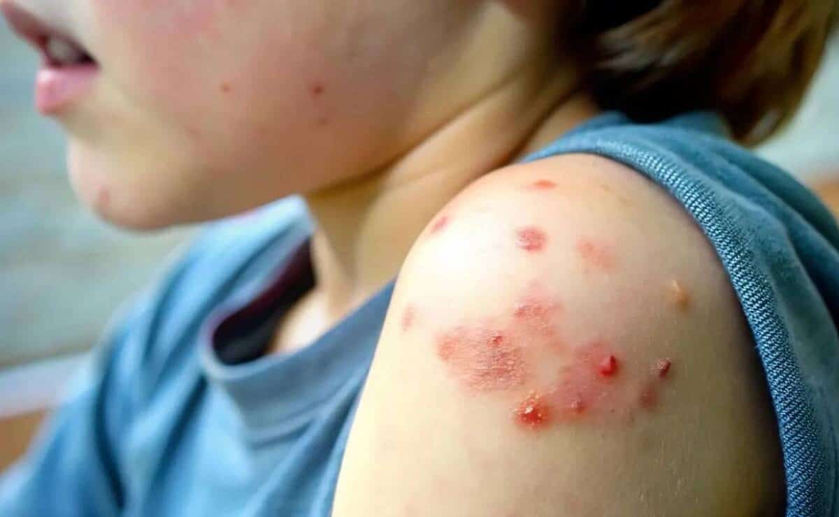 Sarampión en México: Cómo se propaga y cómo protegerte eficazmente