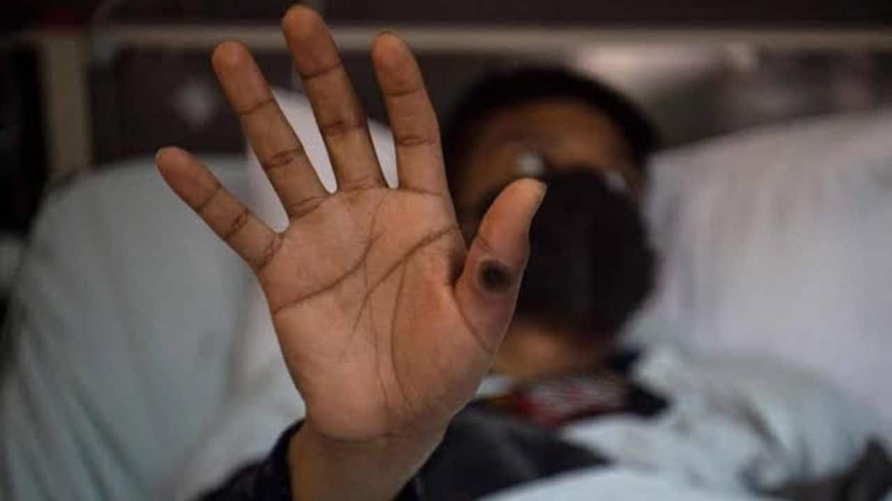 Viruela de mono aumenta 33% en Quintana Roo con 12 casos confirmados en 2025 Viruela de mono aumenta 33% en Quintana Roo con 12 casos confirmados en 2025