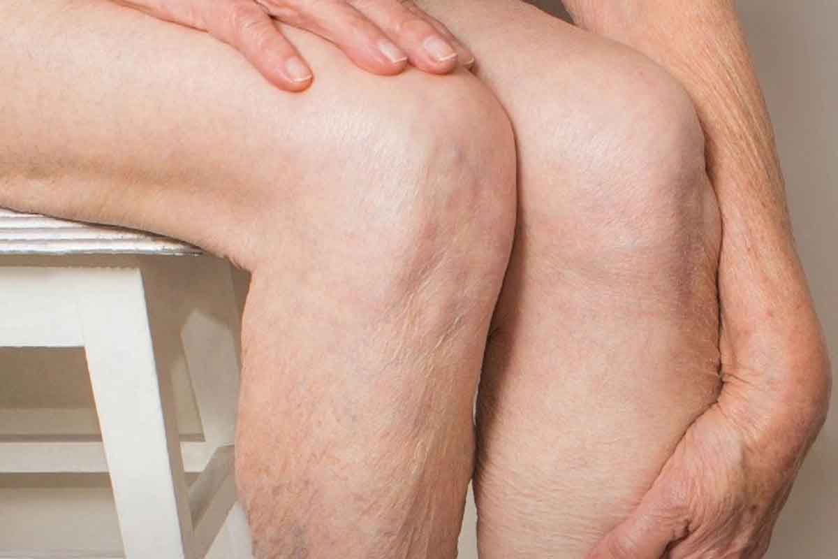 Adultos revelan la verdad oculta sobre la enfermedad venosa Adultos revelan la verdad oculta sobre la enfermedad venosa