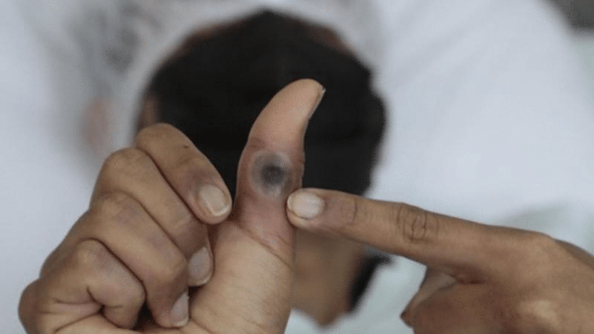 Viruela de mono cierra 2025 con alza de casos en la península de Yucatán