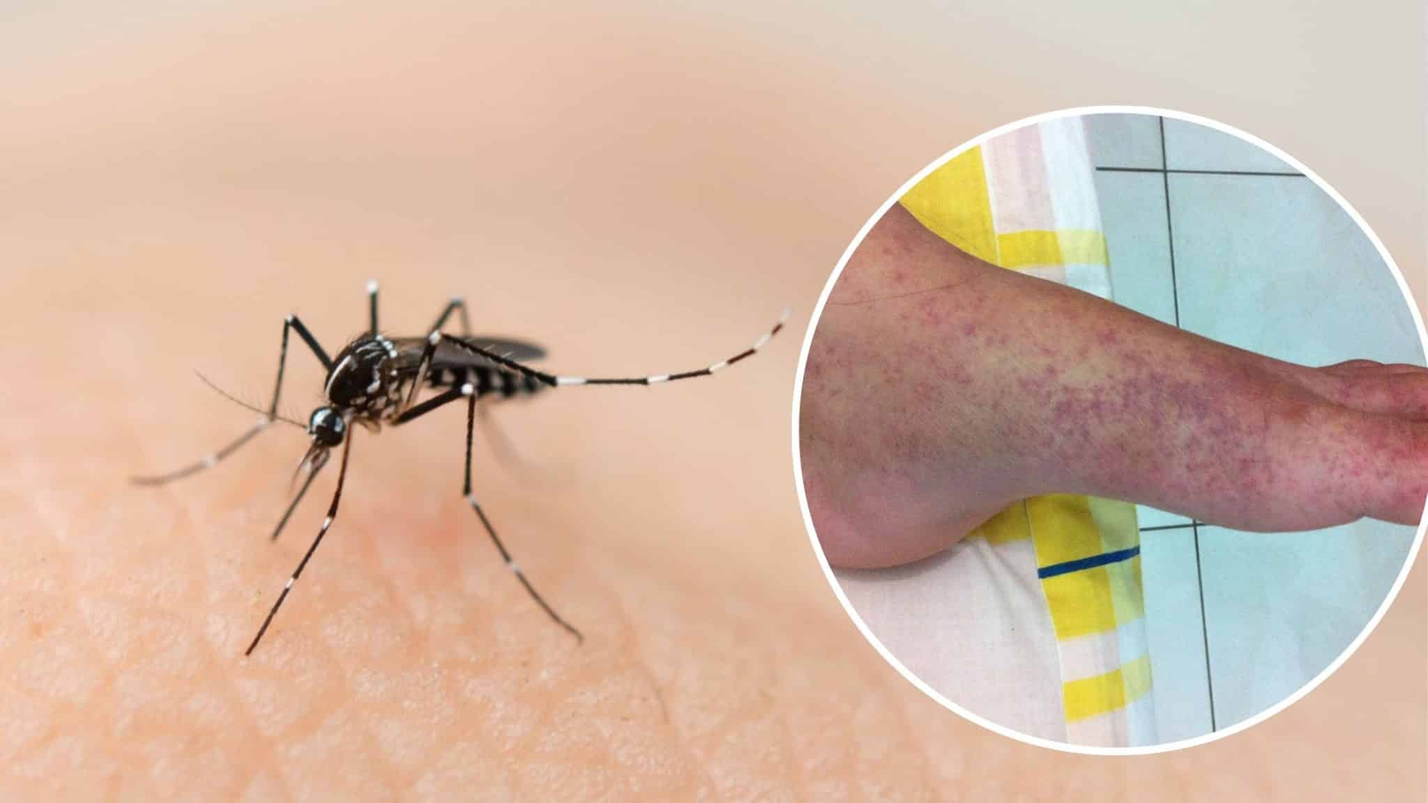 Chikungunya: Quintana Roo registra primer caso del 2026