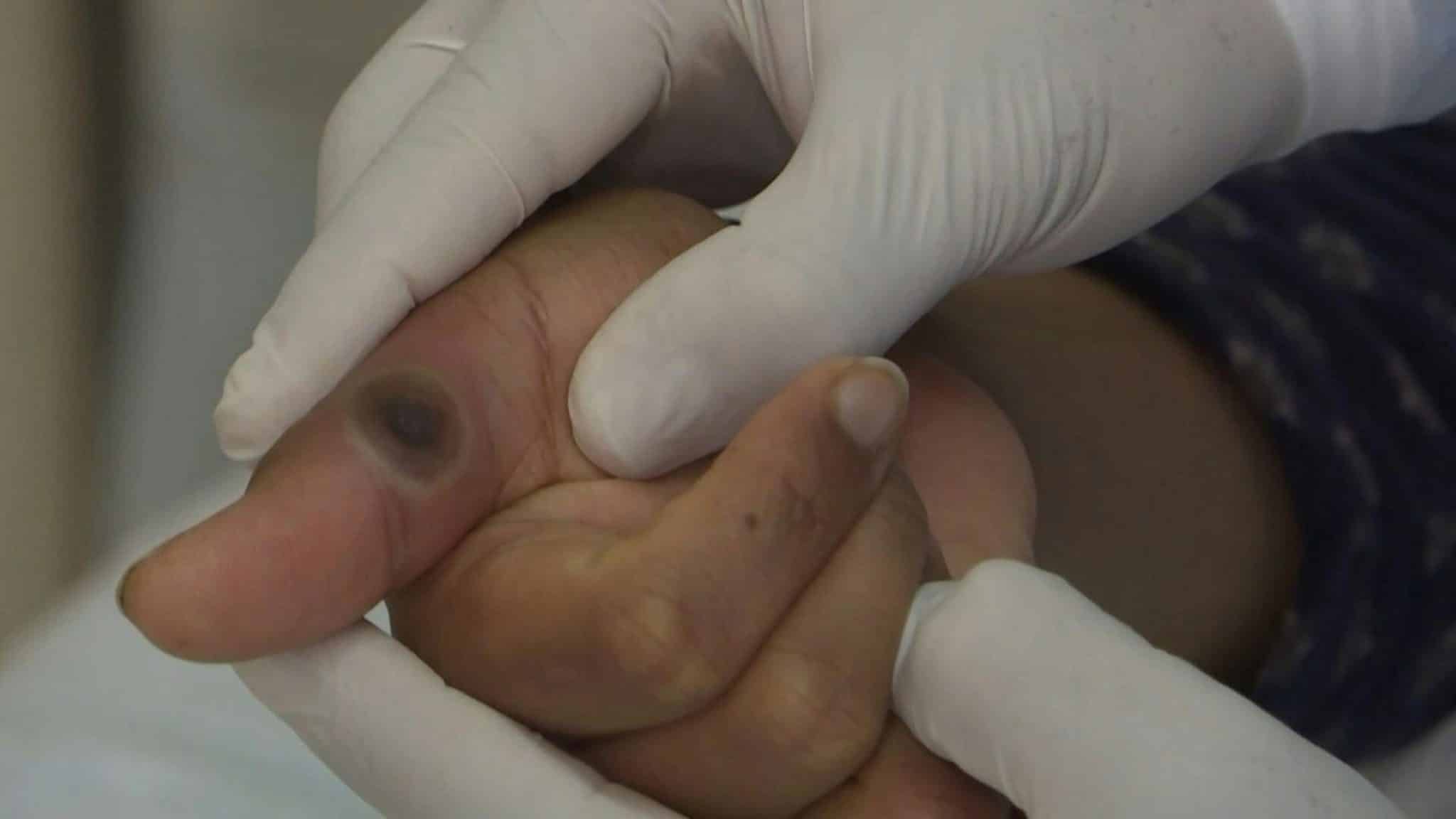 Quintana Roo confirma su primer caso de viruela de mono en 2026 Quintana Roo confirma su primer caso de viruela de mono en 2026