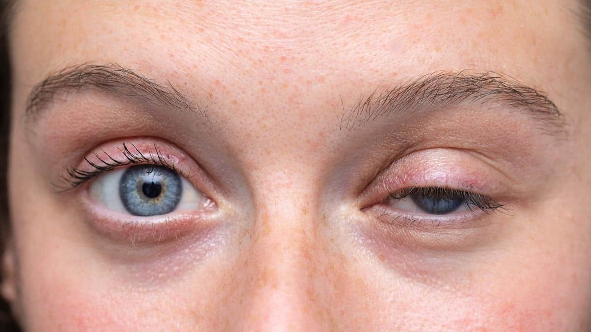Temblor en el ojo cuándo debes preocuparte por el espasmo del párpado Temblor en el ojo: cuándo debes preocuparte por el espasmo del párpado